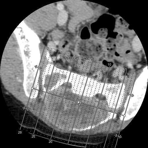 File:Aneurysmal bone cyst - sacrum (Radiopaedia 65190-74195 A 1).jpg