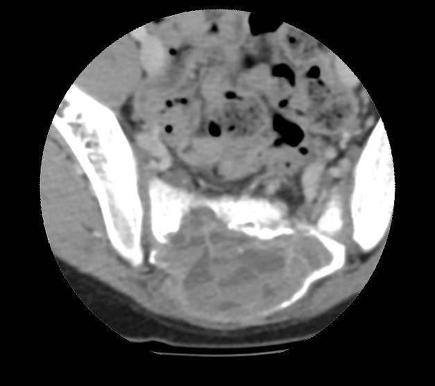 File:Aneurysmal bone cyst - sacrum (Radiopaedia 65190-74195 Axial non-contrast 28).jpg
