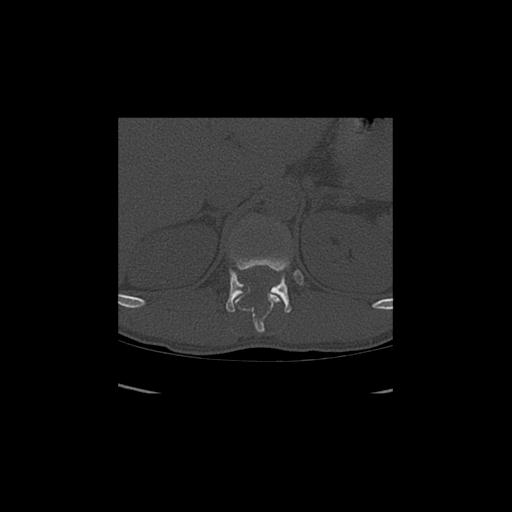 Aneurysmal bone cyst T11 (Radiopaedia 29294-29721 Coronal bone window 1).jpg