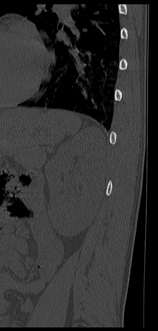 Aneurysmal bone cyst T11 (Radiopaedia 29294-29721 Sagittal bone window 2).jpg