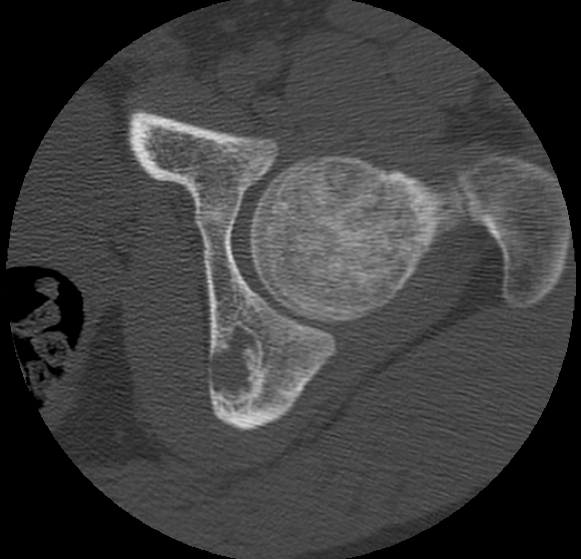 File:Aneurysmal bone cyst of ischium (Radiopaedia 25957-26094 B 15).png