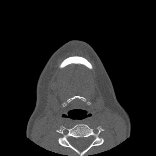 Aneurysmal bone cyst of the mandible (Radiopaedia 43280-46823 Axial bone window 7).jpg