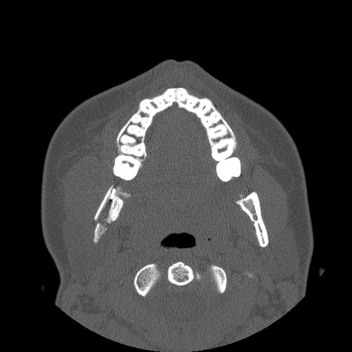 Aneurysmal bone cyst of the mandible (Radiopaedia 43280-46823 Axial bone window 81).jpg