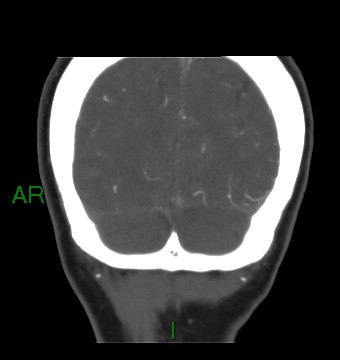 File:Aneurysmal subarachnoid hemorrhage with intra-axial extension (Radiopaedia 84371-99732 C 18).jpg