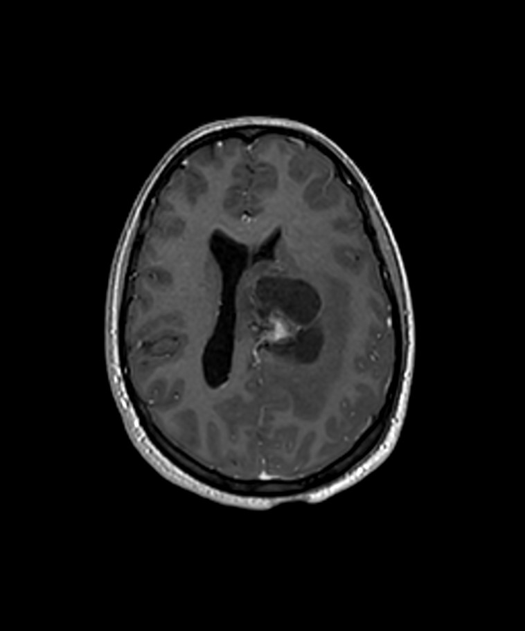 Angiomatous meningioma (Radiopaedia 79459-92577 Axial T1 C+ 3D ISO 17).jpg