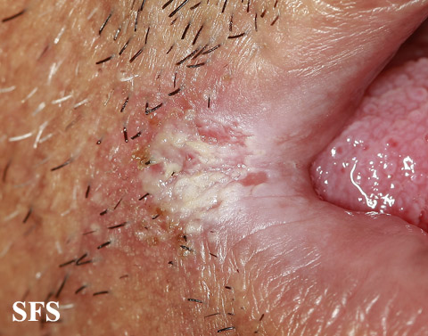 Angular Cheilitis (Dermatology Atlas 4).jpg
