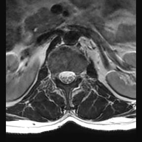 File:Ankylosing spondylitis with zygapophyseal arthritis (Radiopaedia 38433-40516 Axial T2 20).jpg
