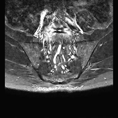 File:Ankylosing spondylitis with zygapophyseal arthritis (Radiopaedia 38433-40517 D 3).jpg
