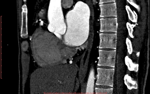 File:Anomalous left coronary artery from the pulmonary artery (ALCAPA) (Radiopaedia 70148-80181 C 107).jpg
