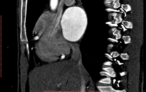 File:Anomalous left coronary artery from the pulmonary artery (ALCAPA) (Radiopaedia 70148-80181 C 68).jpg