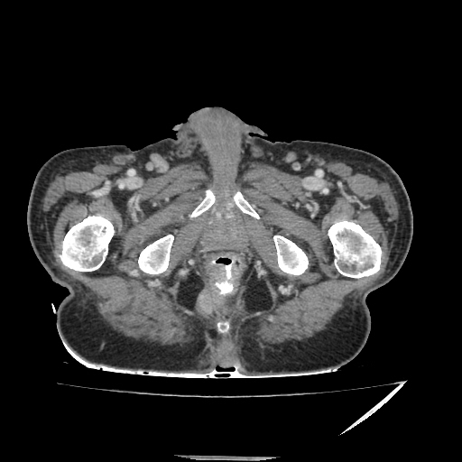 Anorectal carcinoma (Radiopaedia 44413-48064 A 57).jpg