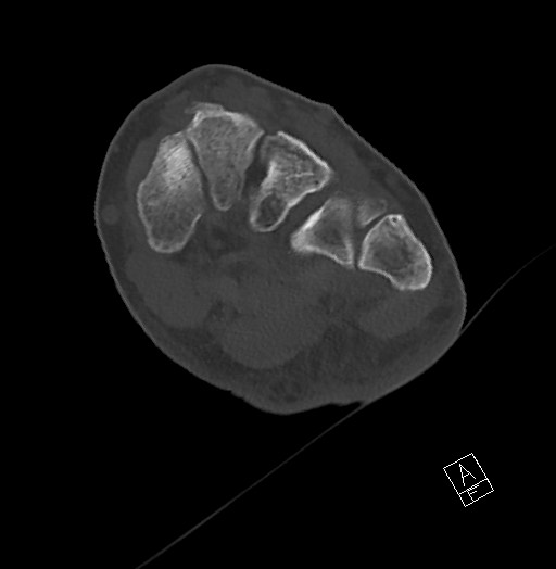 Anterior calcaneal process fracture (Radiopaedia 63353-71943 Axial bone window 80).jpg