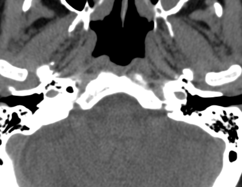 Anterior cervical postdiscectomy arthrodesis (Radiopaedia 32678-33646 Axial non-contrast 1).jpg