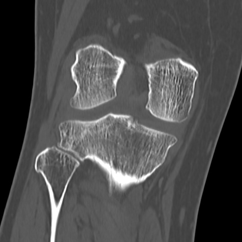 File:Anterior cruciate ligament avulsion fracture (Radiopaedia 58939-66194 Coronal bone window 21).jpg