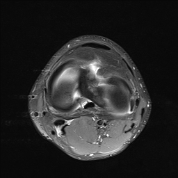 File:Anterior cruciate ligament full thickness tear (Radiopaedia 66268-75467 Axial PD fat sat 18).jpg