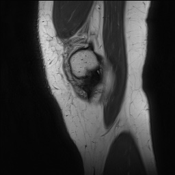 File:Anterior cruciate ligament rupture and posteromedial corner injury (Radiopaedia 67338-76723 Sagittal PD 26).jpg