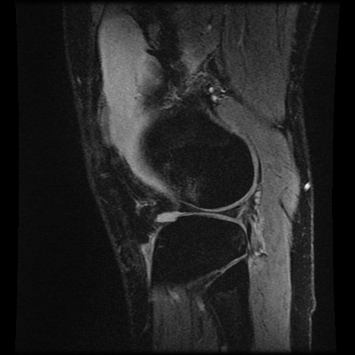 Anterior cruciate ligament tear (Radiopaedia 61500-69462 F 74).jpg