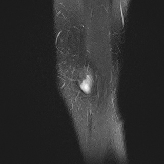 File:Anterior cruciate ligament tear - pediatric (Radiopaedia 62152-70260 Sagittal PD fat sat 5).jpg