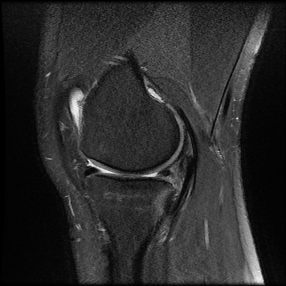 File:Anterior cruciate ligament tear with posteromedial corner injury, bucket-handle meniscal tear and chondral delamination (Radiopaedia 75501-86744 Sagittal PD fat sat 8).jpg