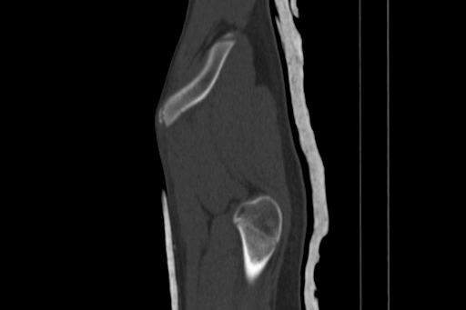 Anterior inferior iliac spine avulsion injury (Radiopaedia 88666-105376 Sagittal bone window 14).jpg