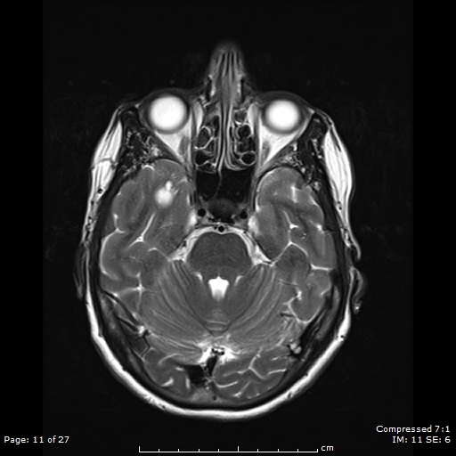 File:Anterior temporal lobe perivascular space (Radiopaedia 88283-104914 Axial T2 11).jpg