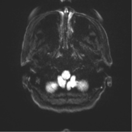 Anterior temporal pole cysts (Radiopaedia 46629-51102 Axial DWI 30).png