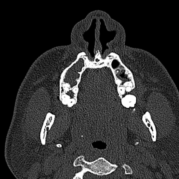 Antrochoanal polyp (Radiopaedia 30002-30554 Axial bone window 10).jpg