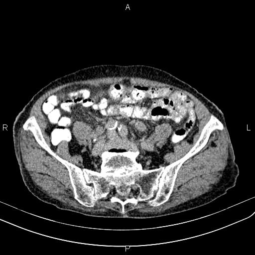Aortic aneurysm and Lemmel syndrome (Radiopaedia 86499-102554 Axial C+ delayed 57).jpg