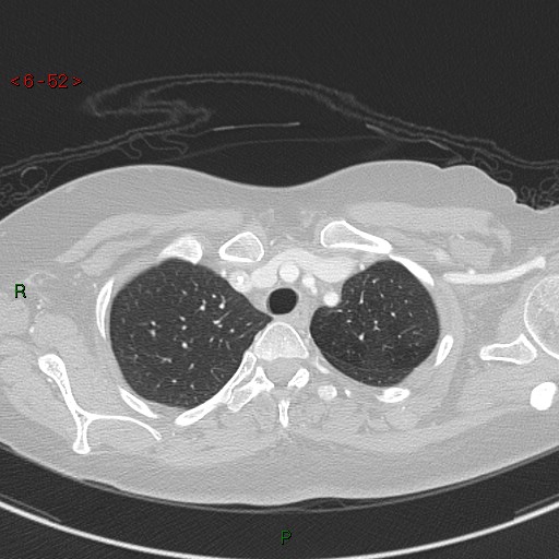 File:Aortic arch origin of left vertebral artery (Radiopaedia 51520-57286 Axial lung window 52).jpg
