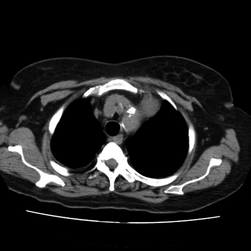Aortic arch pseudoaneurysm (Radiopaedia 8534-9368 Axial non-contrast 13).jpg