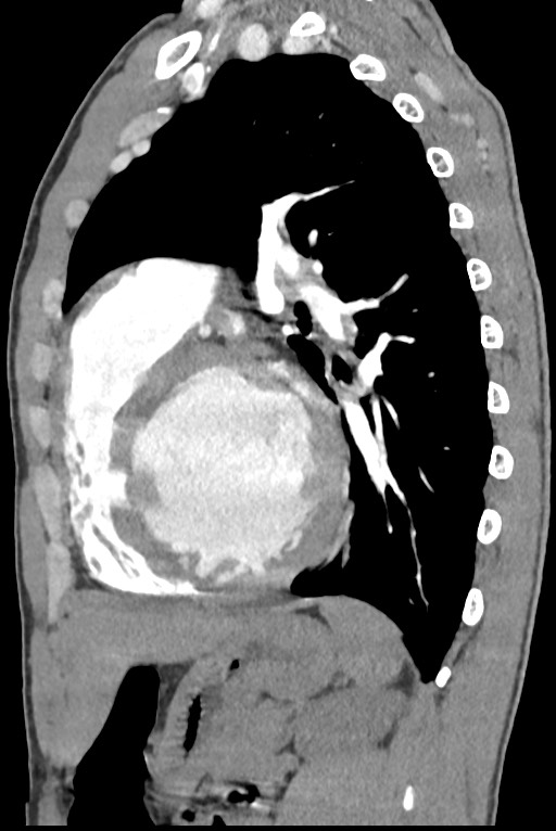 Aortic coarctation with aneurysm (Radiopaedia 74818-85828 B 106).jpg