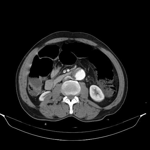 Aortic dissection- Stanford type A (Radiopaedia 22085-22085 A 53).jpg