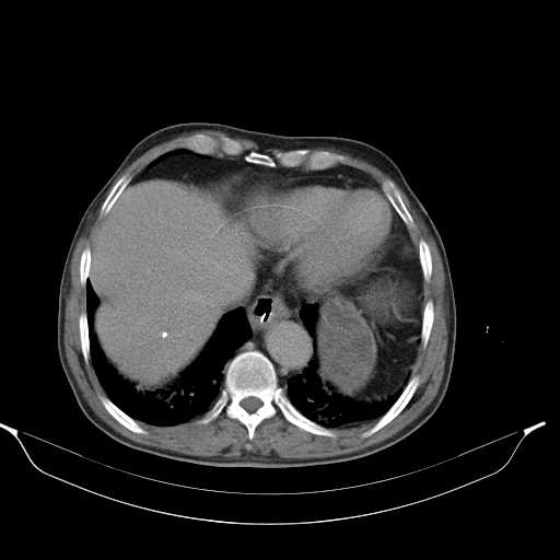 File:Aortic dissection- Stanford type A (Radiopaedia 22085-22085 Axial C+ delayed 6).jpg