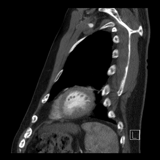 File:Aortic dissection (CTPA) (Radiopaedia 75506-86750 C 87).jpg