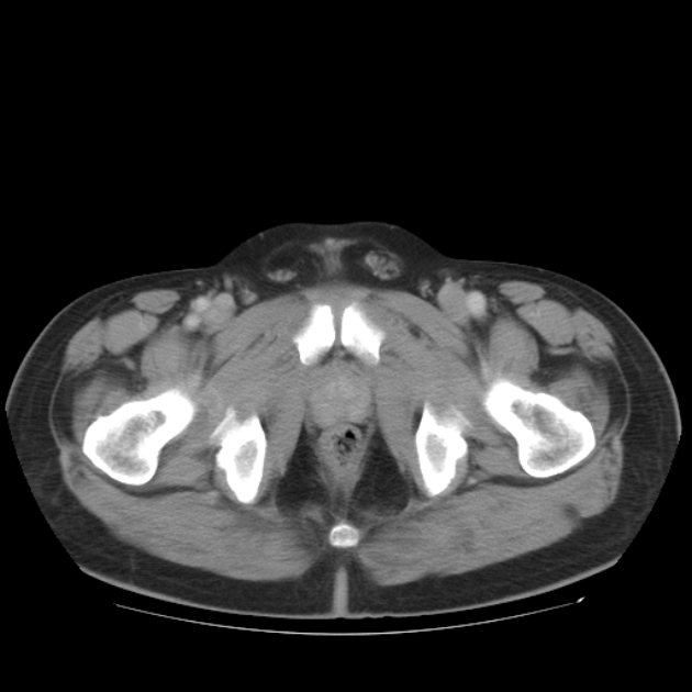 Aortic dissection (Radiopaedia 44411-48061 C 105).jpg