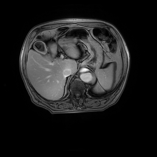 File:Aortic dissection - Stanford A - DeBakey I (Radiopaedia 23469-23551 Axial MRA 37).jpg