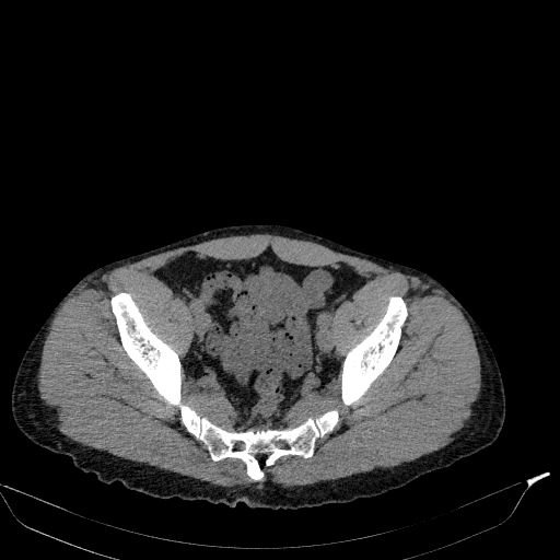Aortic dissection - Stanford type A (Radiopaedia 83418-98500 Axial non-contrast 82).jpg