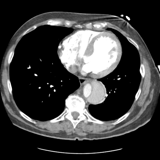 File:Aortic dissection - Stanford type B (Radiopaedia 50171-55512 A 34).png