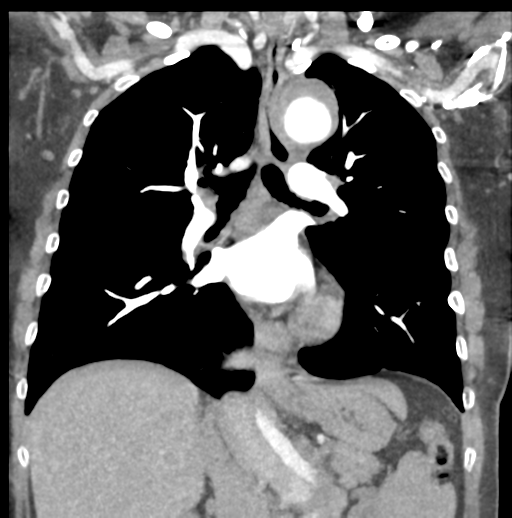 File:Aortic dissection - Stanford type B (Radiopaedia 50171-55512 B 45).png
