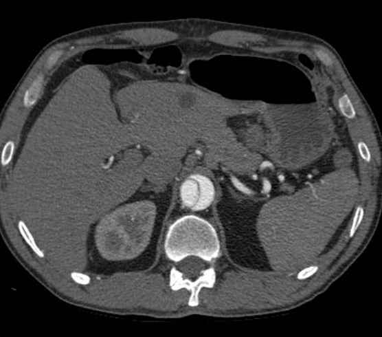 Aortic dissection - Stanford type B (Radiopaedia 73648-84437 A 119).jpg