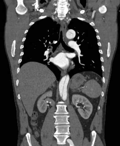 File:Aortic dissection - Stanford type B (Radiopaedia 73648-84437 B 70).jpg
