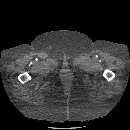 Aortic dissection - Stanford type B (Radiopaedia 88281-104910 A 171).jpg