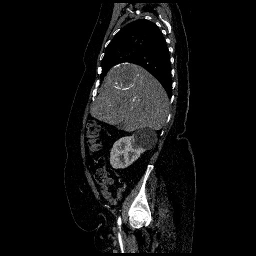 File:Aortic dissection - Stanford type B (Radiopaedia 88281-104910 C 18).jpg