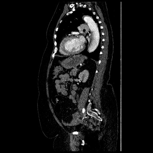 File:Aortic dissection - Stanford type B (Radiopaedia 88281-104910 C 57).jpg