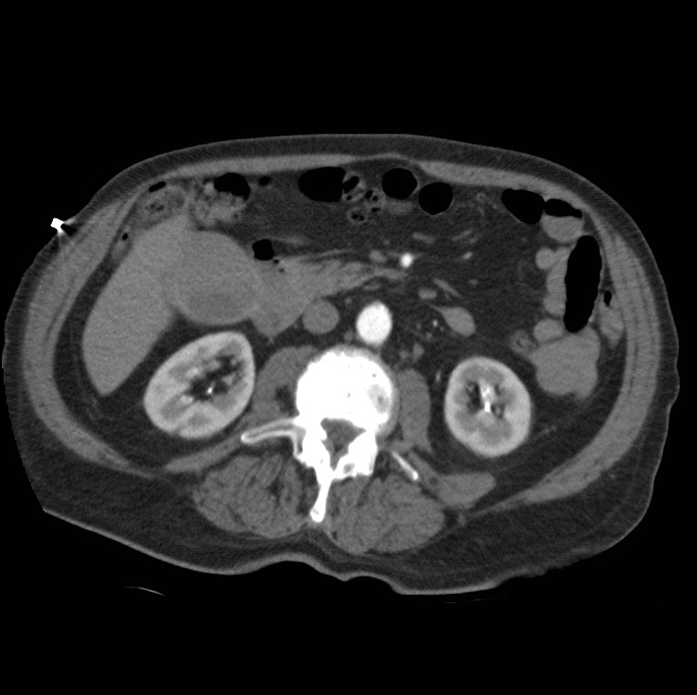 Aortic dissection with rupture into pericardium (Radiopaedia 12384-12647 A 64).jpg