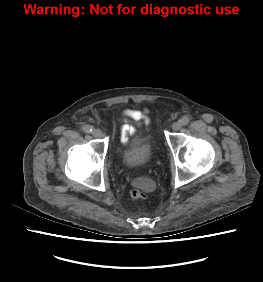 Aortic graft infection (Radiopaedia 44979-48907 Axial non-contrast 86).jpg