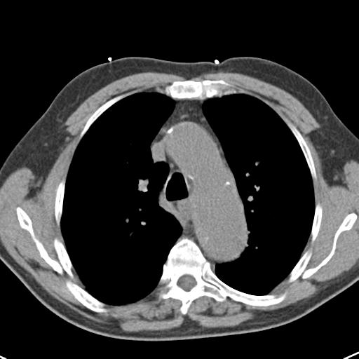 Aortic intramural hematoma (Radiopaedia 31139-31838 Axial non-contrast 19).jpg