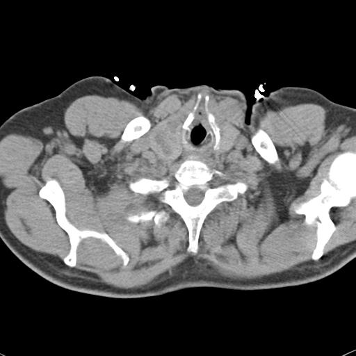 Aortic intramural hematoma (Radiopaedia 31139-31838 Axial non-contrast 3).jpg