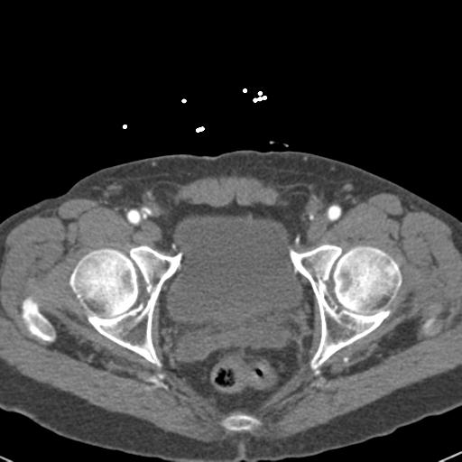File:Aortic intramural hematoma (Radiopaedia 31139-31838 B 163).jpg