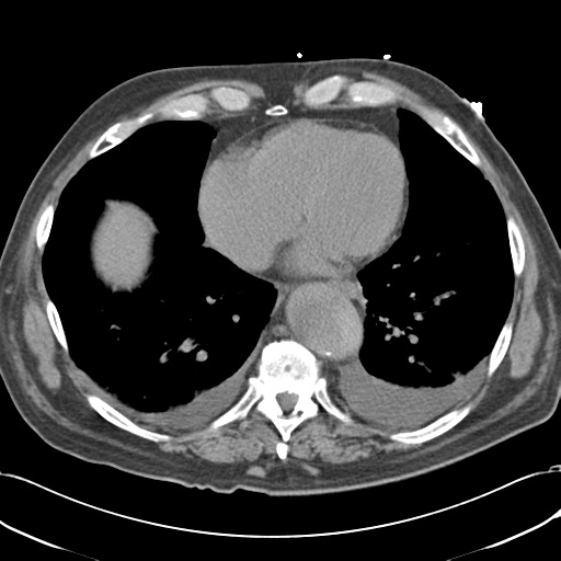 Aortic intramural hematoma (Radiopaedia 34260-35540 Axial non-contrast 44).png